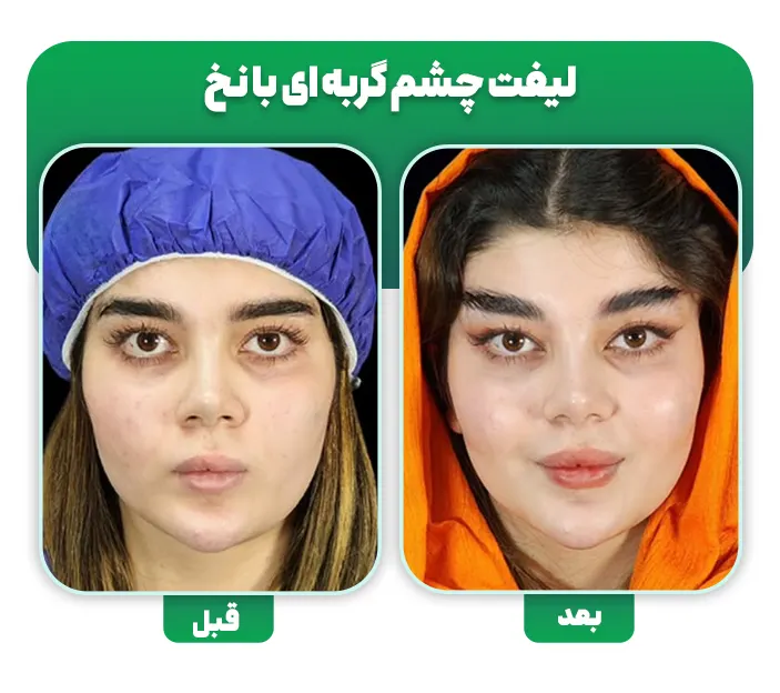 لیفت چشم گربه ای با نخ قبل و بعد