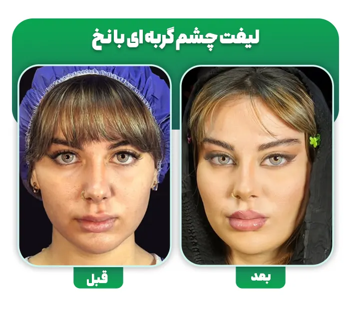 لیفت چشم گربه ای با نخ قبل و بعد