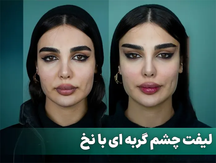 لیفت چشم گربه ای با نخ