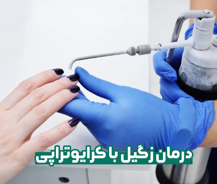 کرایوتراپی زگیل