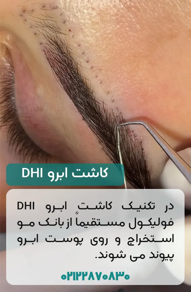 کاشت ابرو به روش DHI