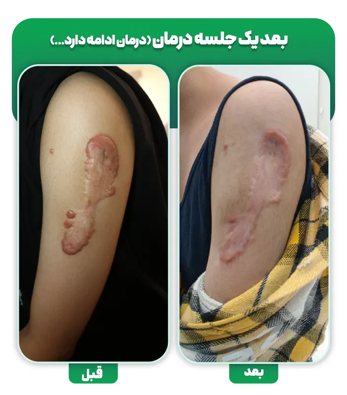 درمان کلوئید با لیزر