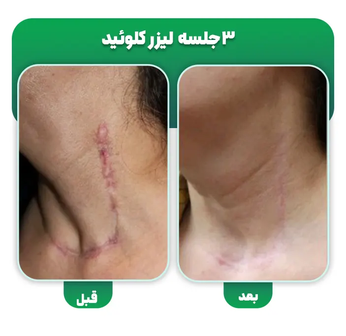 بعد سه جلسه لیزر کلوئید