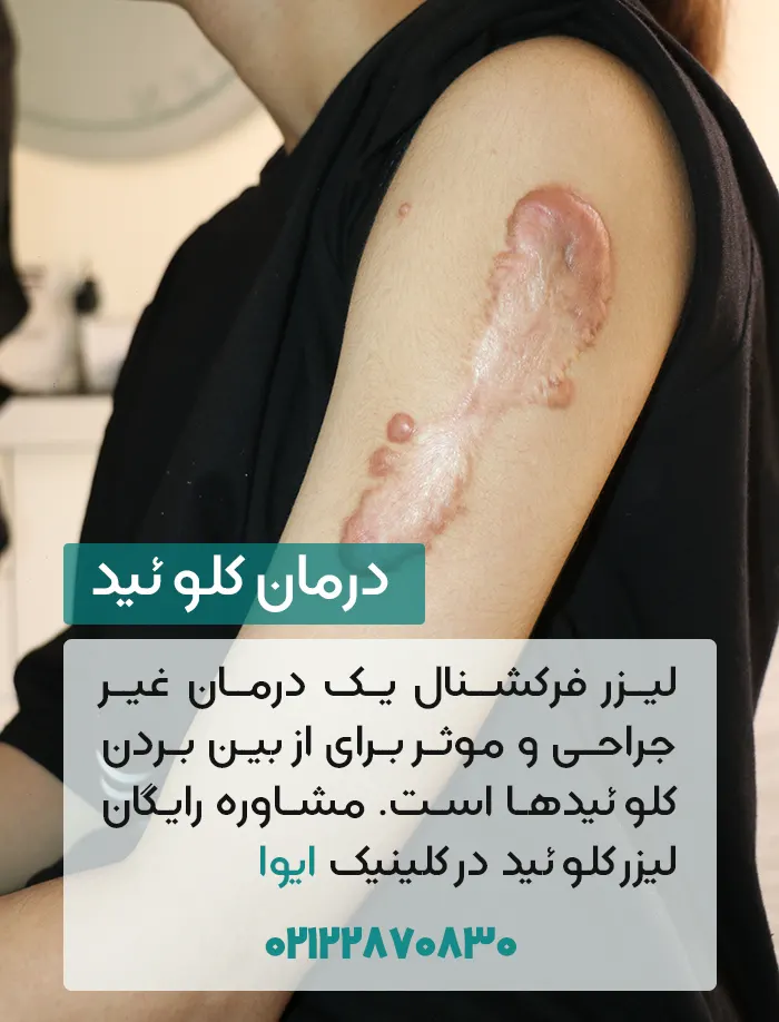 درمان کلوئید با لیزر فرکشنال