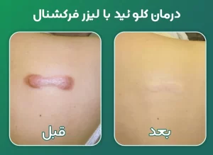 درمان کلوئید با لیزر فرکشنال