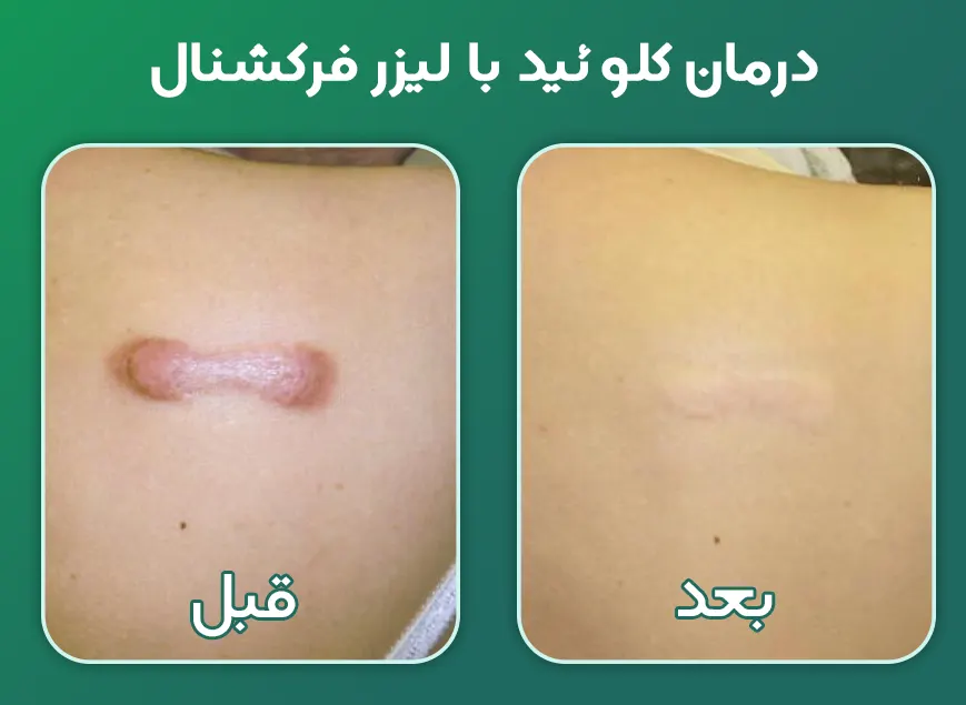 درمان کلوئید با لیزر فرکشنال