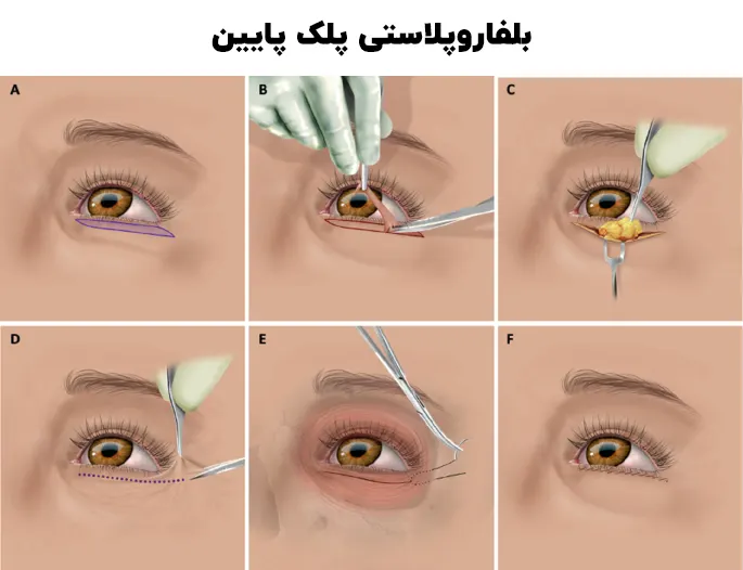 بفاروپلاستی پلک پایین