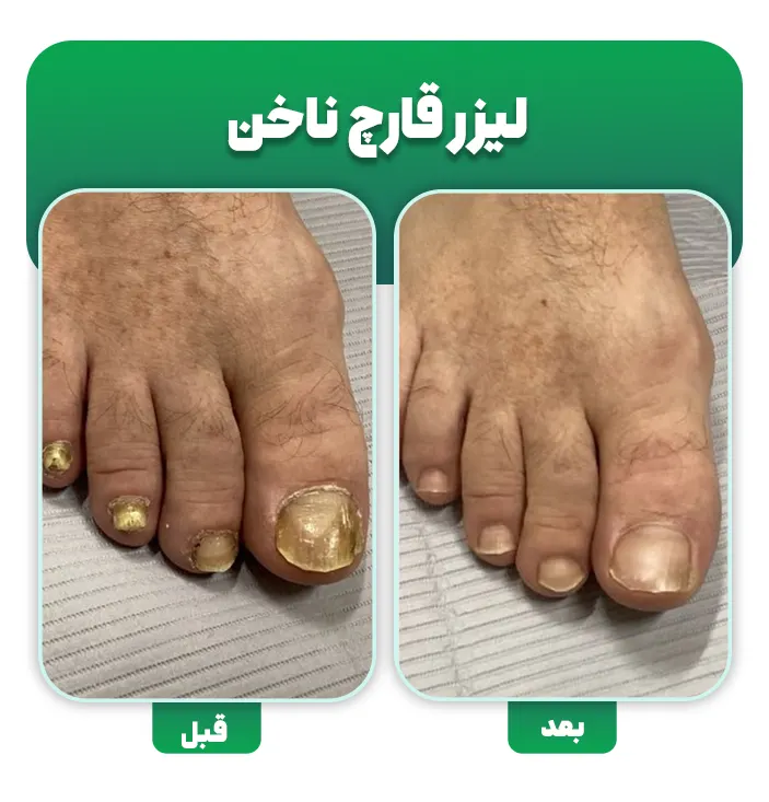 درمان قارچ ناخن با لیزر