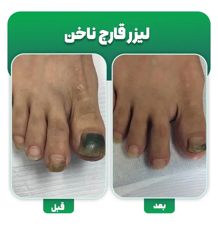 قبل و بعد لیزر قارچ ناخن