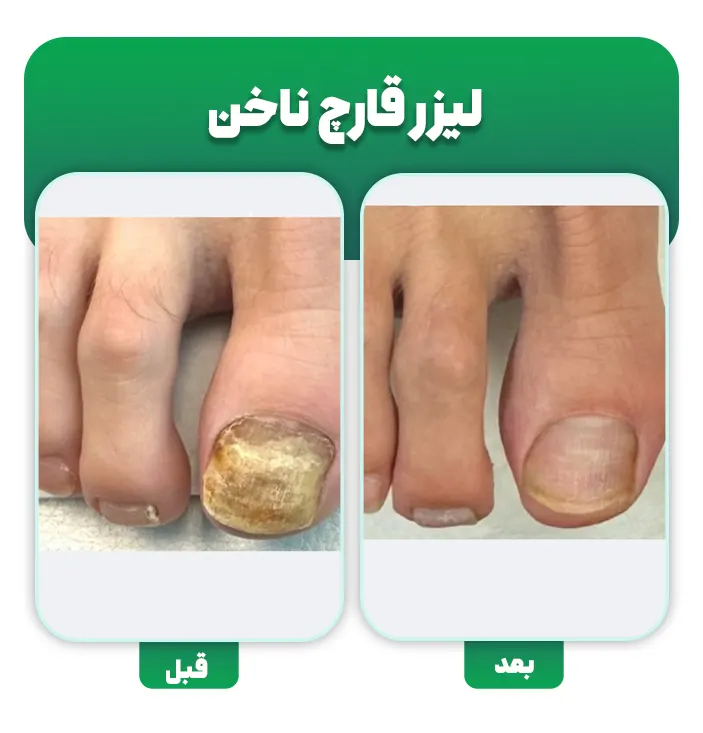 قبل و بعد لیزر قارچ ناخن
