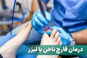 درمان قارچ ناخن با لیزر