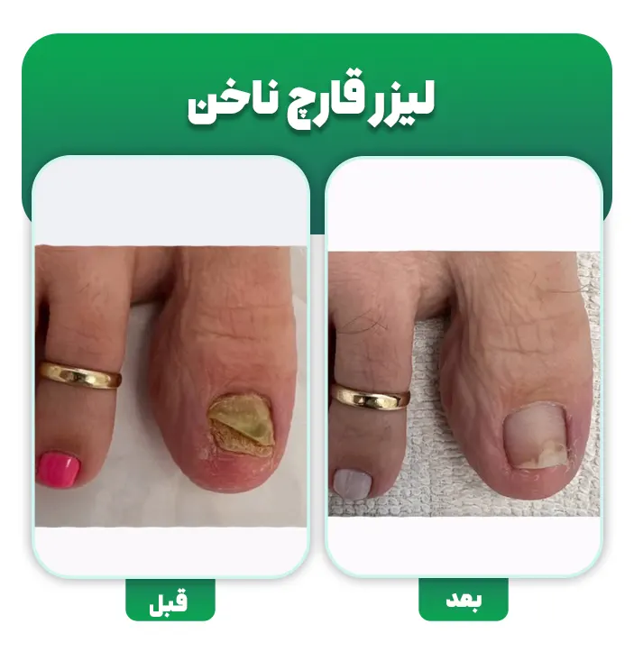 درمان قارچ ناخن با لیزر قبل و بعد