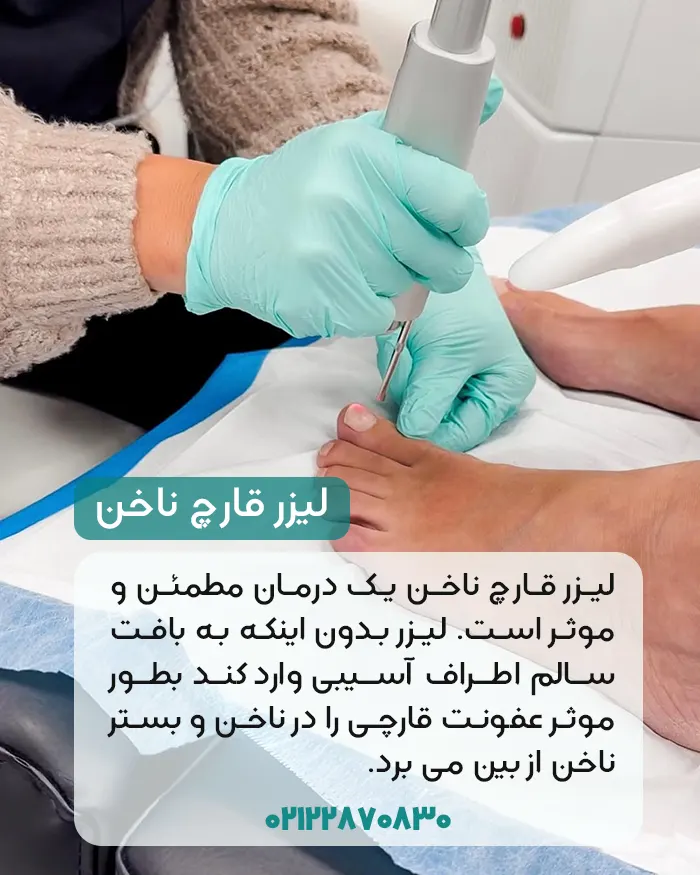 درمان قارچ ناخن با لیزر