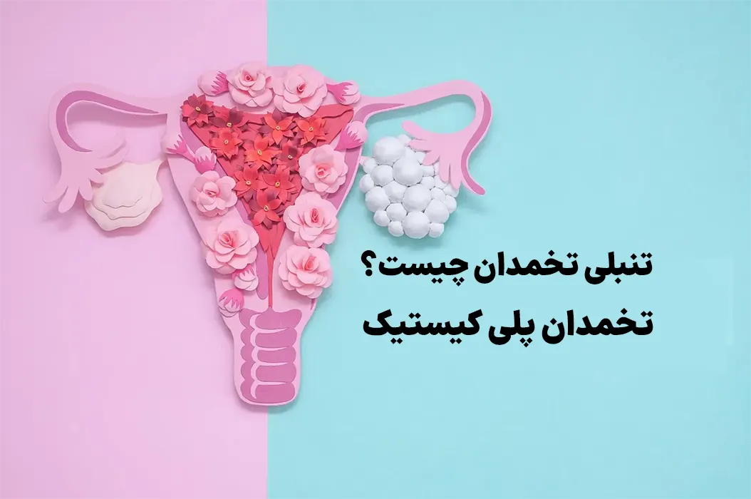 تنبلی تخمدان