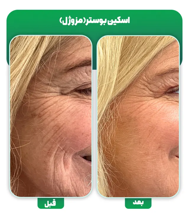 قبل بعد اسکین بوستر