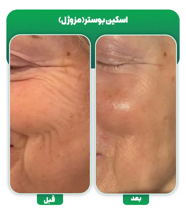 قبل بعد اسکین بوستر مزوژل