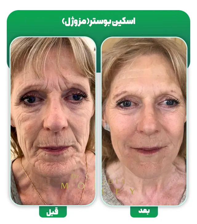 قبل بعد اسکین بوستر مزوژل