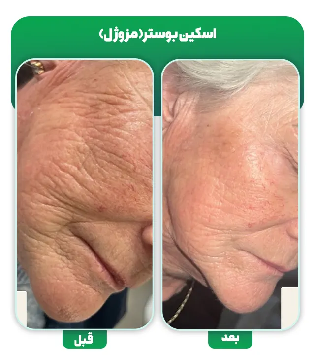 قبل بعد مزوژل