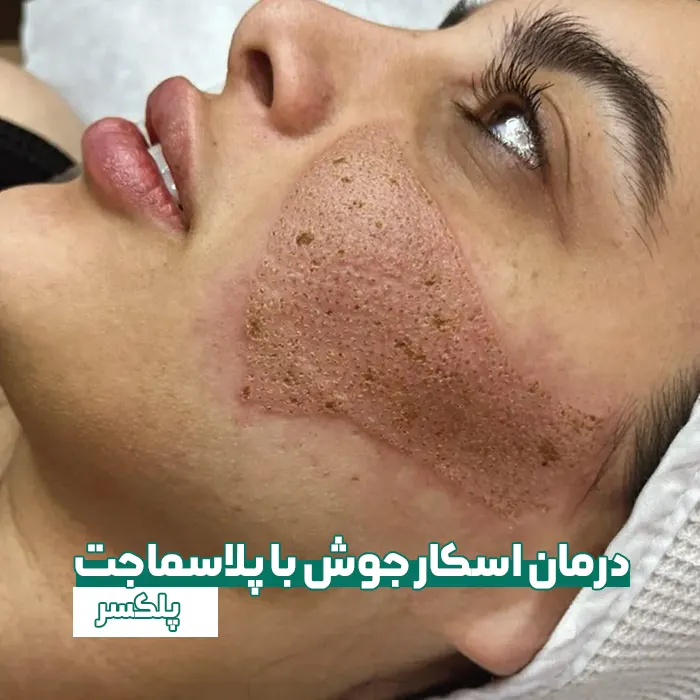 درمان جای جوش با پلاسماجت