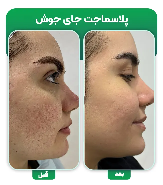 درمان اسکار جای جوش با پلاسماجت