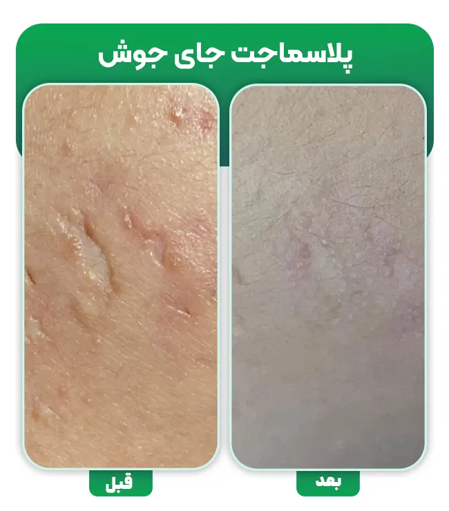 درمان جای جوش با پلاسماجت