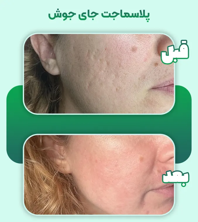 درمان جای جوش با پلاسماجت
