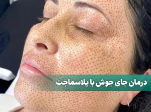 درمان جای جوش با پلاسماجت