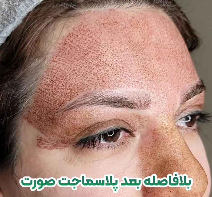 بلافاصله بعد پلاسماجت