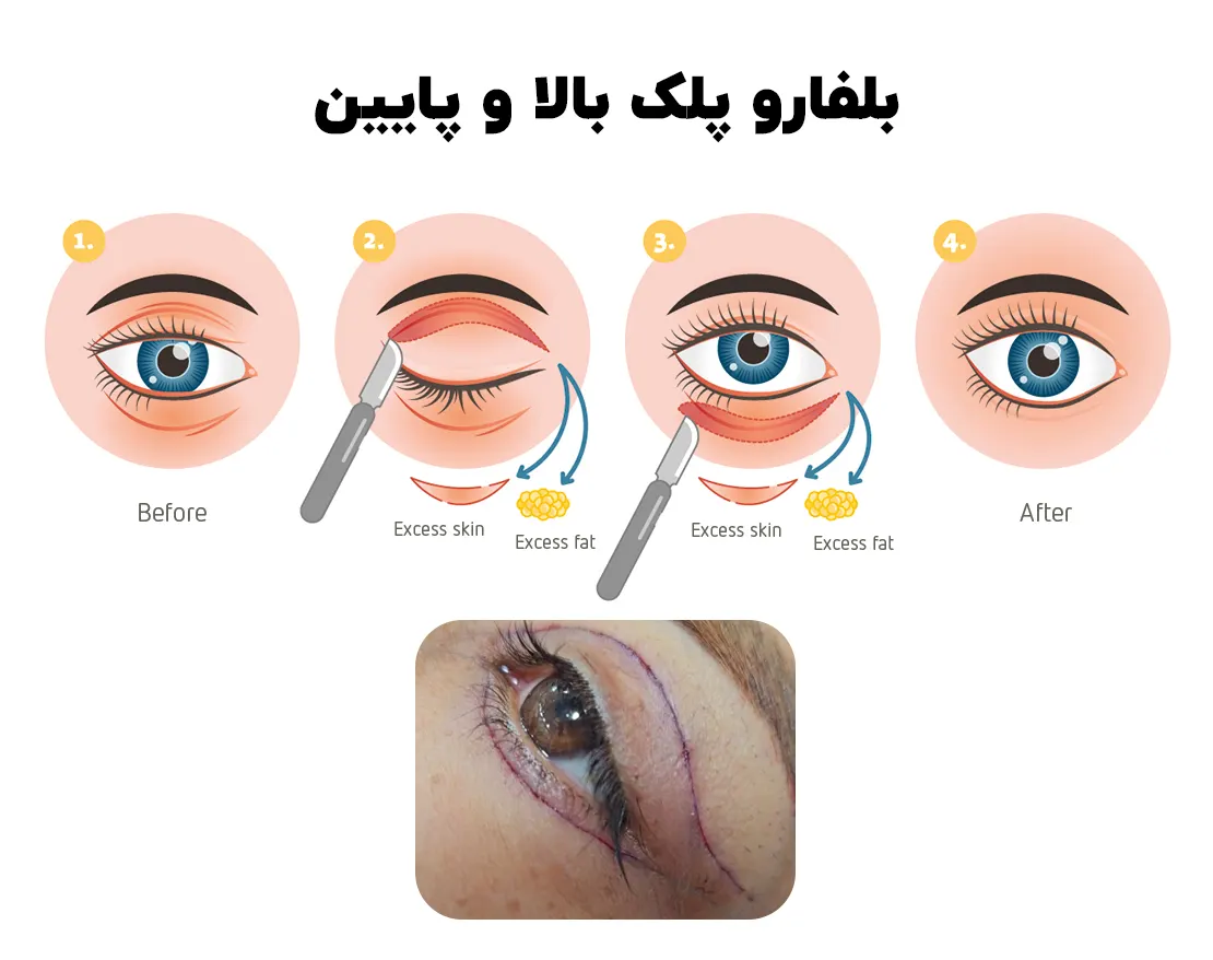 بلفاروپلاستی پلک بالا و پایین