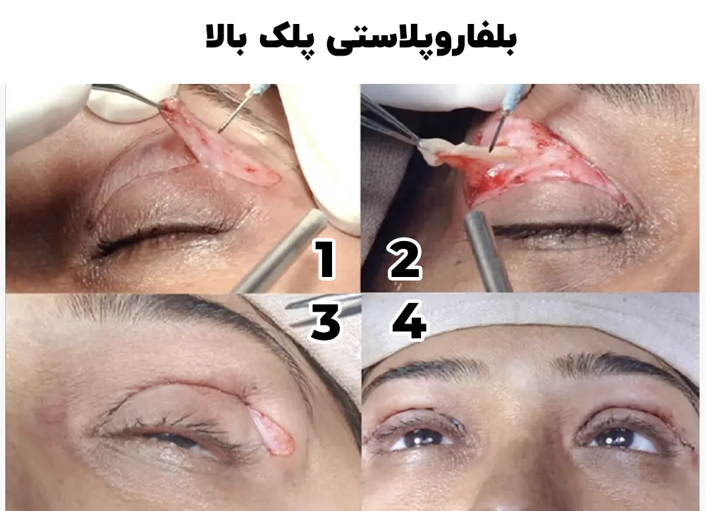 بلفاروپلاستی پلک بالا