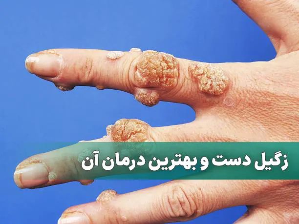 زگیل دست و درمان آن