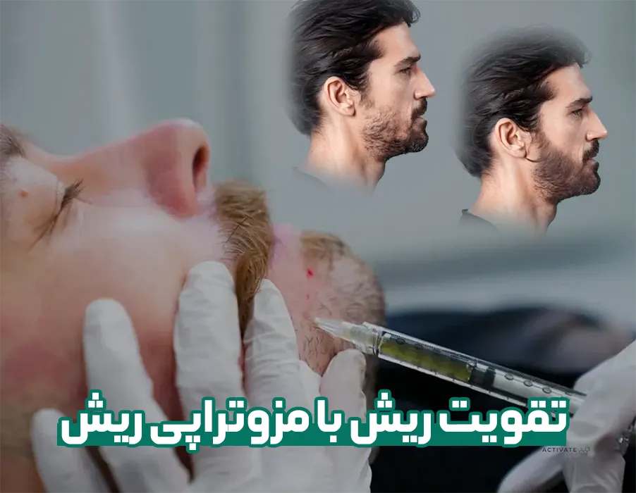 مزوتراپی ریش