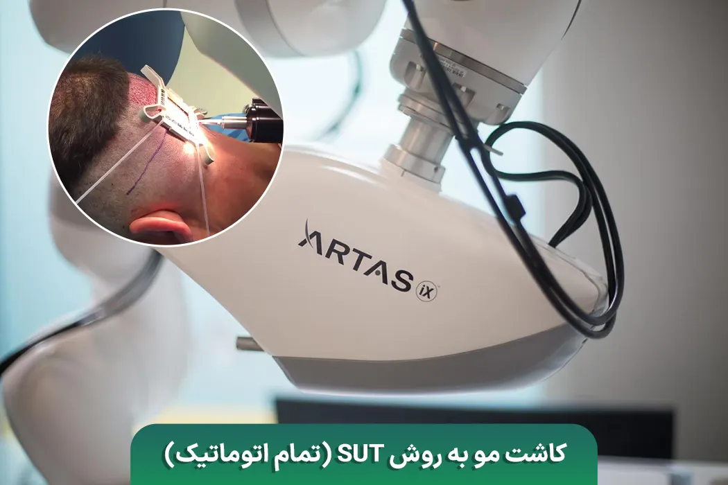 کاشت مو به روش SUT تمام اتوماتیک