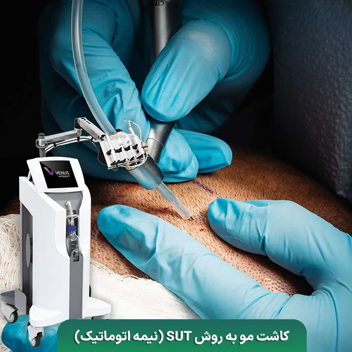 کاشت مو به روش SUT نیمه اتوماتیک