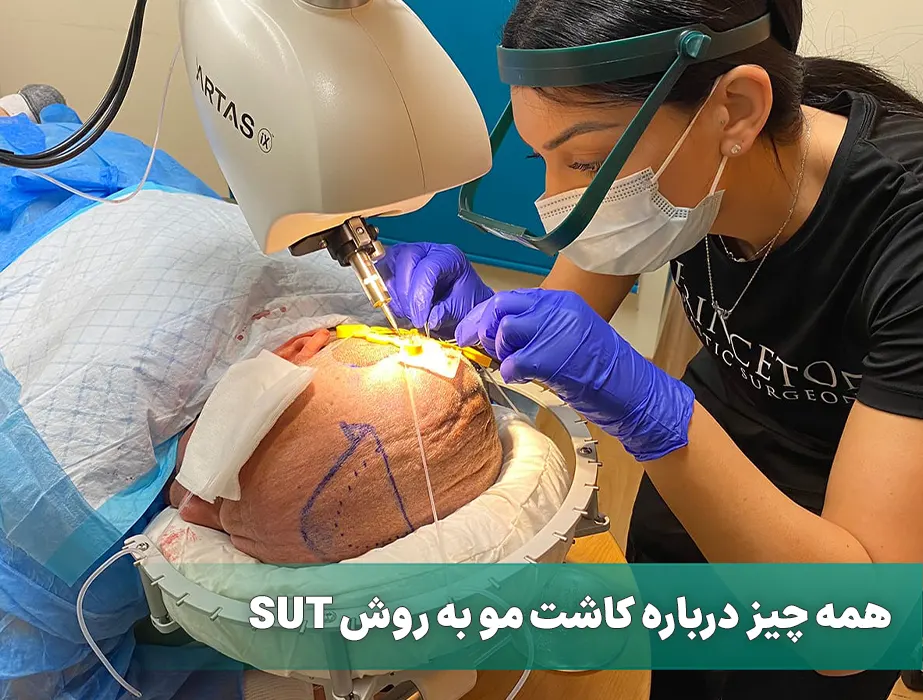 کاشت مو به روش SUT