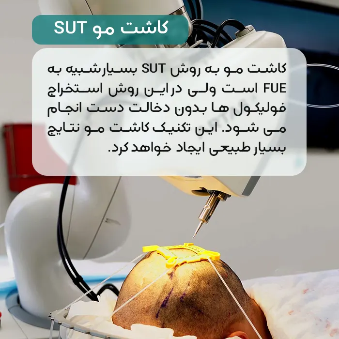 کاشت مو به روش SUT