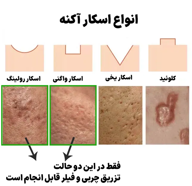 اسکار آکنه