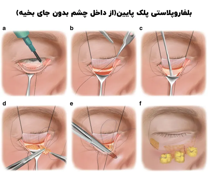 بفاروپلاستی پلک پایین از داخل چشم