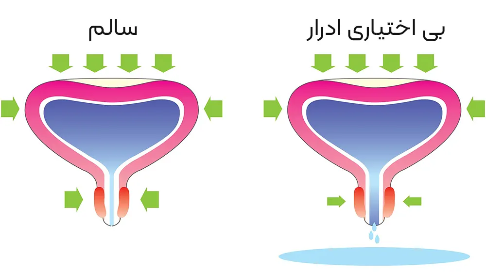 بی اختیاری ادرار