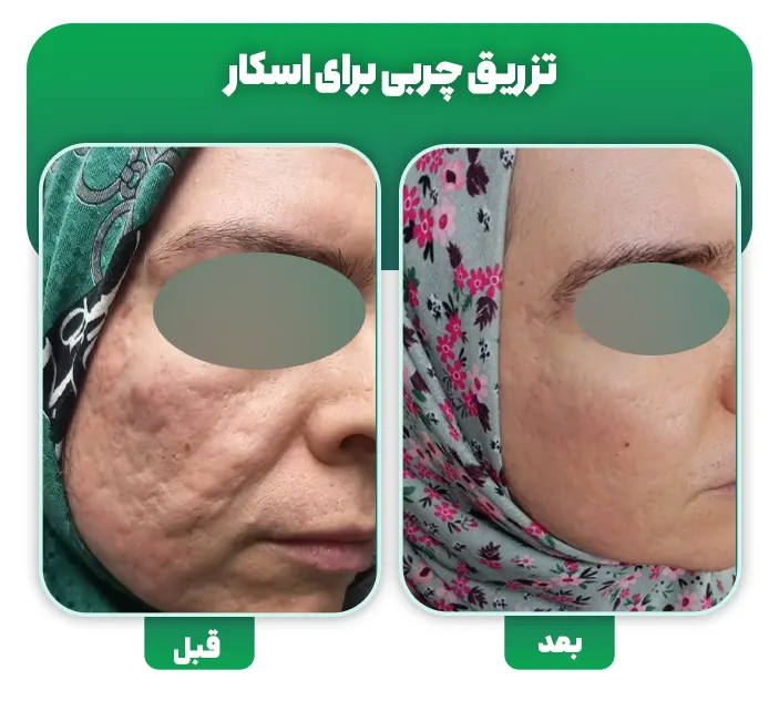 تزریق چربی اسکار آکنه