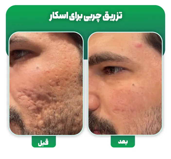 تزریق چربی اسکار آکنه