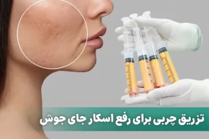 تزریق چربی برای رفع اسکار جای جوش