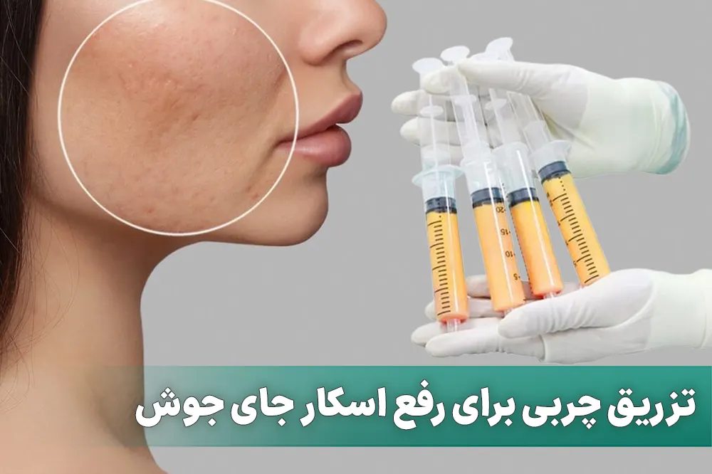 تزریق چربی برای رفع اسکار جای جوش