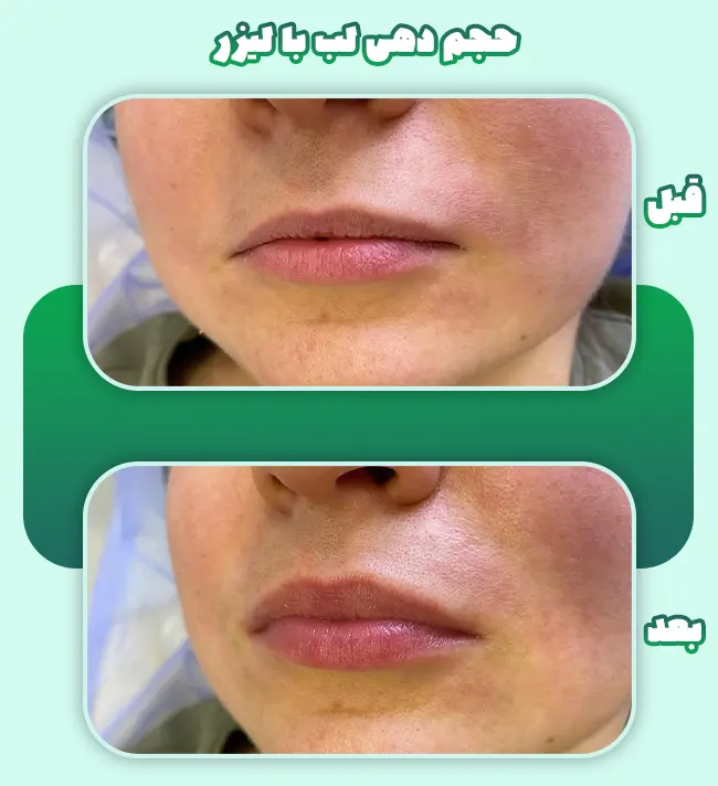حجم دهی لب با لیزر