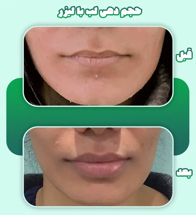 حجم دهی لب با لیزر
