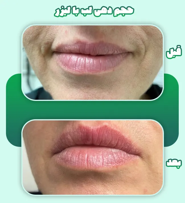 حجم دهی لب با لیزر