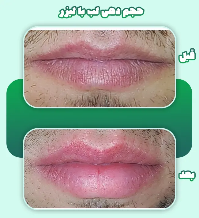 حجم دهی لب با لیزر