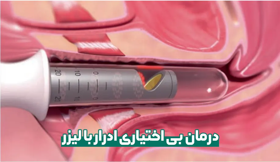 درمان بی اختیاری ادرار با لیزر