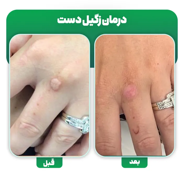 درمان زگیل دست قبل و بعد