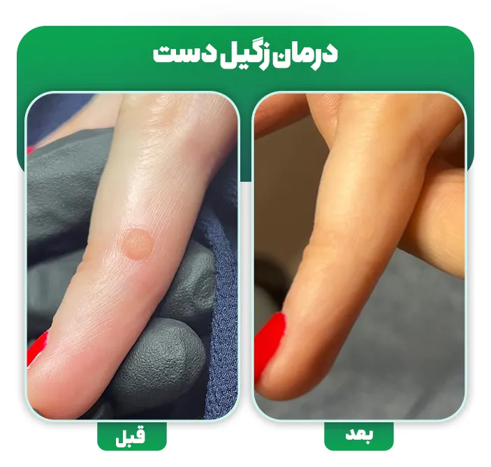 درمان زگیل دست
